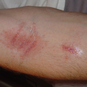  Rash On Mans Arm